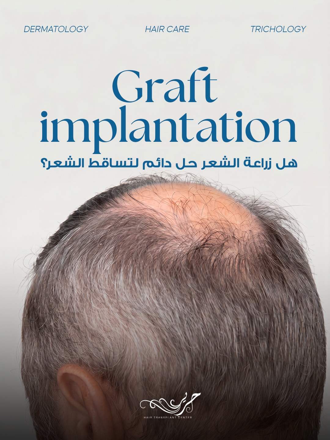 هل زراعة الشعر حل دائم لتساقط الشعر؟ دليلك إلى النتائج الطبيعية والطويلة الأمد 1 هل زراعة الشعر حل دائم لتساقط الشعر؟ دليلك إلى النتائج الطبيعية والطويلة الأمد
