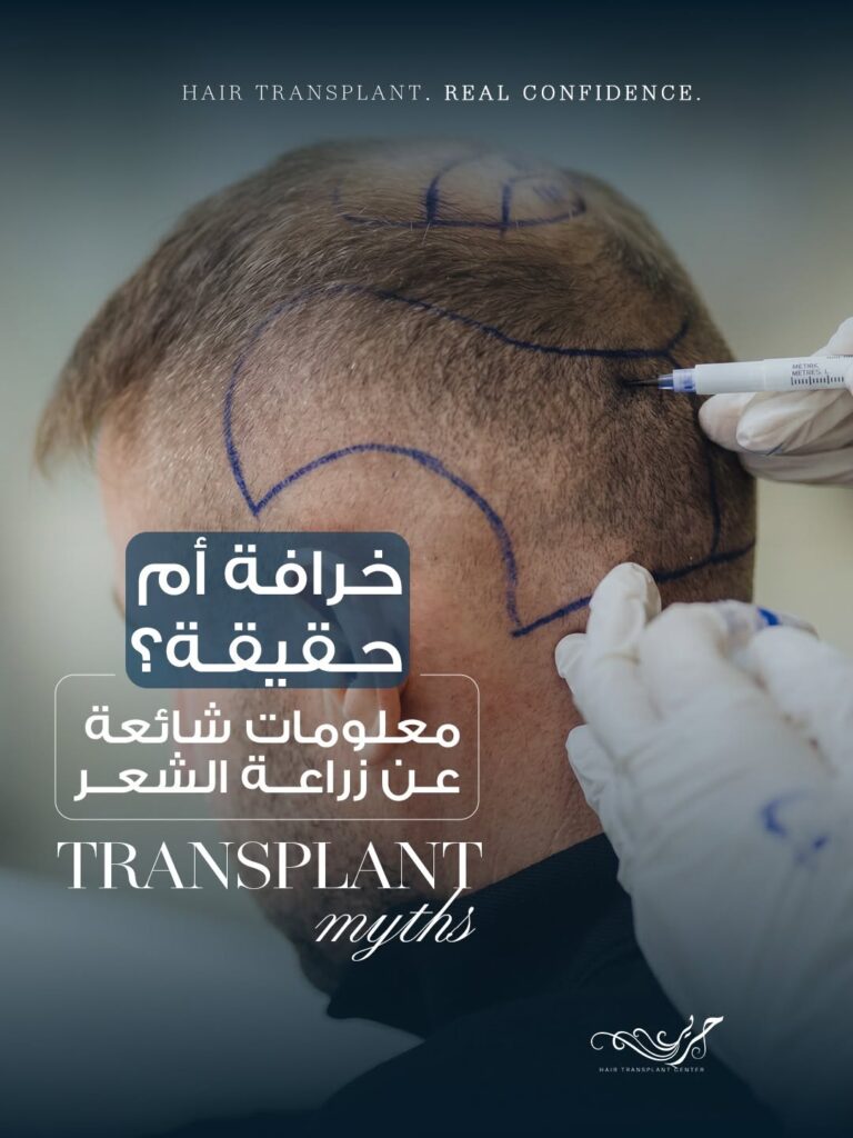 10 خرافات عن زراعة الشعر... والحقيقة التي يجب أن تعرفها
